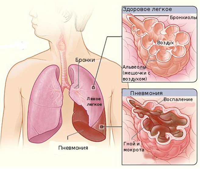Пневмония (воспаление легких)