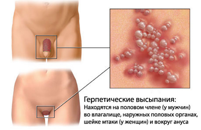 Генитальный (половой) герпес