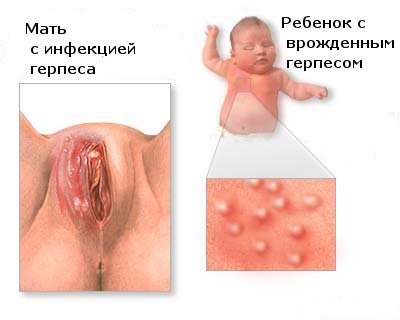 от чего бывают прыщи от чего бывают прыщи