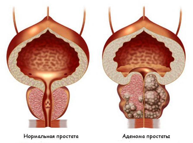 Аденома простаты  (доброкачественная гиперплазия предстательной железы)