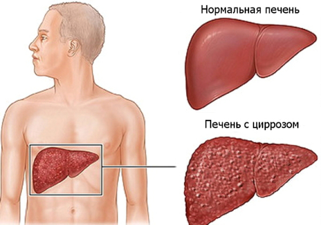 Цирроз печени