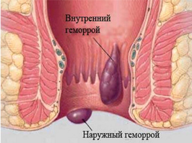 Геморрой