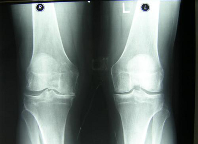 Рентгенограмма остеоартроза коленных суставов