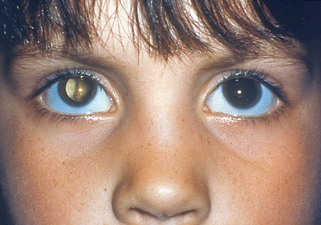 Хрусталик глаза, замутненный катарактой