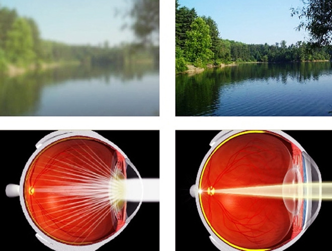 Фиксирование нечеткого изображение сетчаткой глаза из-за катаракты хрусталика