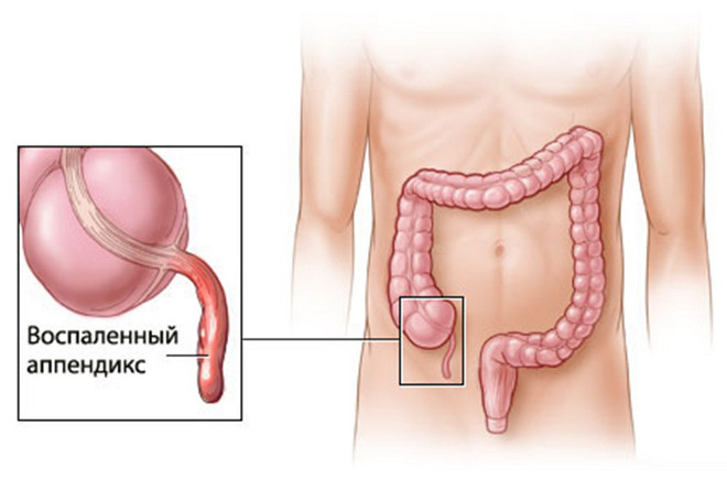 Аппендицит - воспаление аппендикса