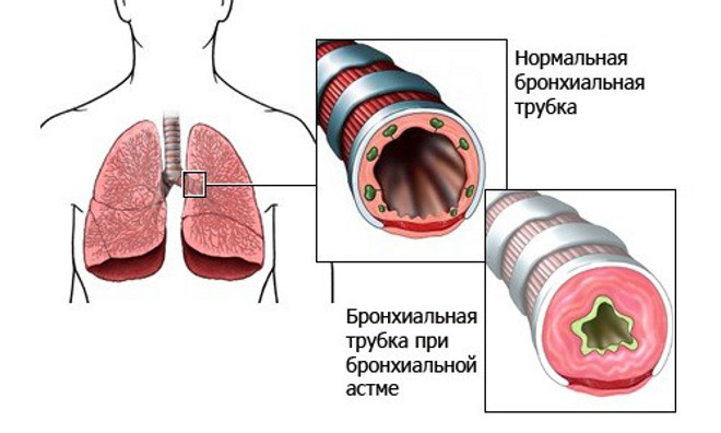 Перекрытие бронхов при бронхиальной астме