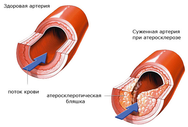 Суженнная артерия при атеросклерозе