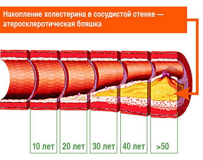 Возрастное накопление холестерина в сосудистой стенке