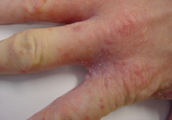 Поврежденные участки кожи между пальцев рук при чесотке