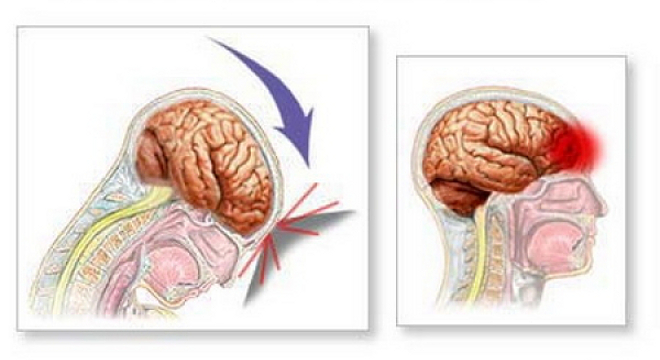 Сотрясение мозга возникает при прямом ударе, либо резком замедлении движения головы. 