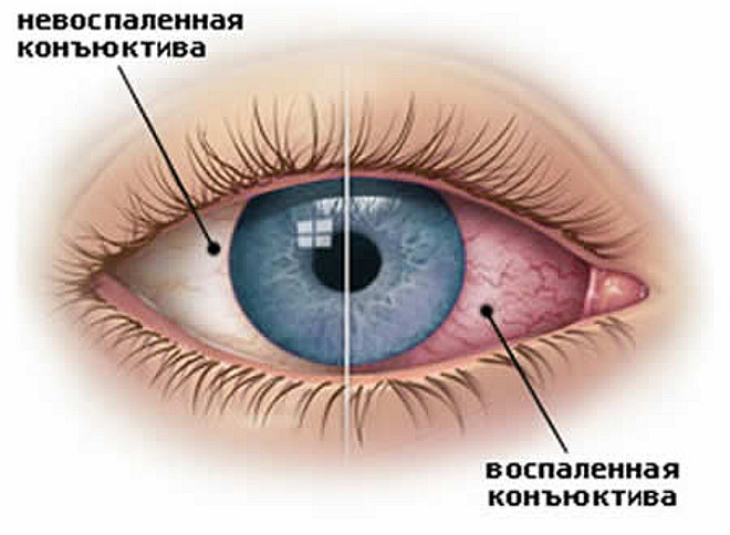 Конъюнктивит - воспаление слизистой оболочки глаза