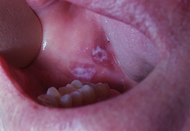 Лейкоплакия слизистой оболочки рта