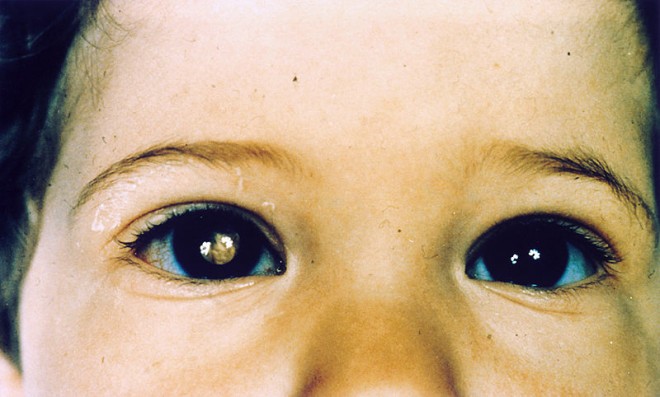 Эффект «кошачьего глаза» при ретинобластоме