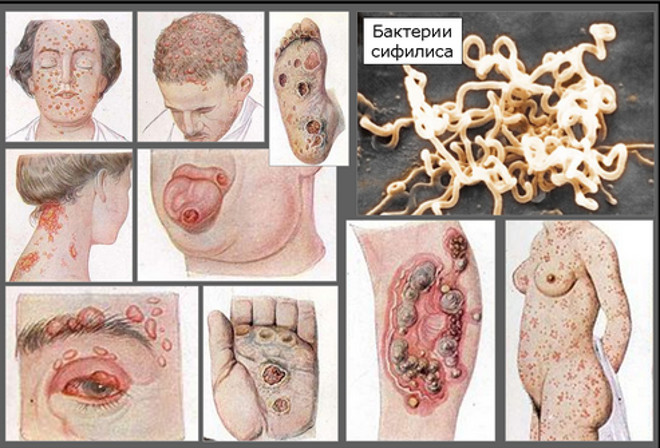 Различные образования на разных участках кожи и слизистых - признак вторичного сифилиса