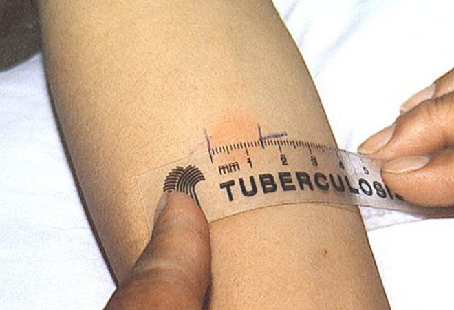 Проба Манту представляет собой кожную пробу, направленную на выявление наличия специфического иммунного ответа на введение туберкулина