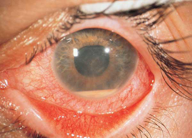 Увеит - воспаление сосудистой оболочки глаза