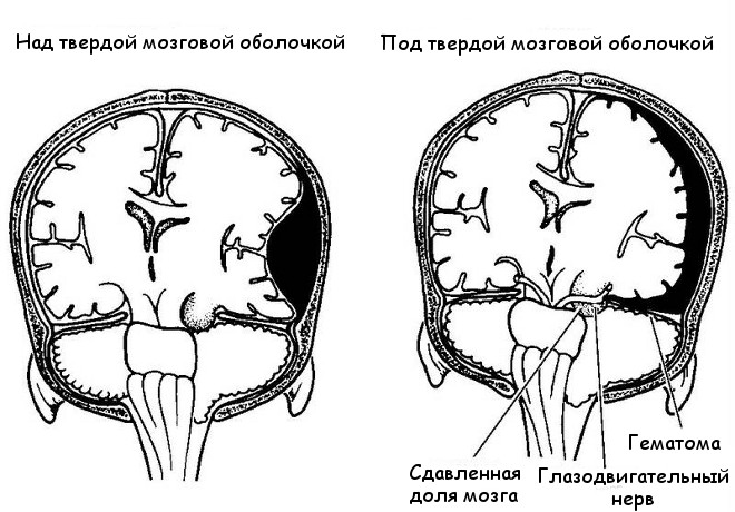 Сдавление головного мозга наблюдается у 3—5% пострадавших с черепно-мозговой травмой.