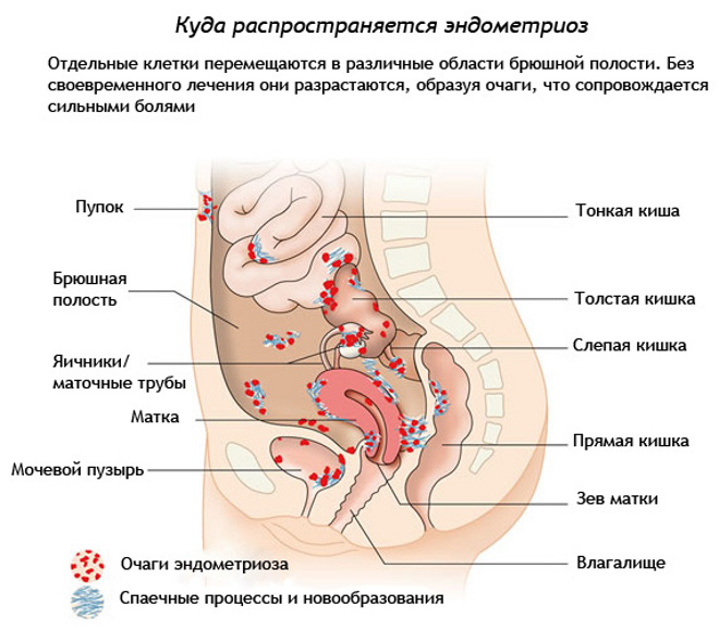 Куда разрастается эндометриоз