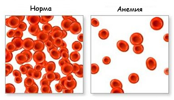 Анемия - недостаток красных кровяных телец