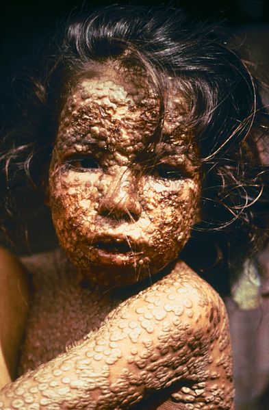 Девочка из Бангладеш, больная натуральной оспой (1973 год). О полном уничтожении оспы в Бангладеш было объявлено в декабре 1977 года, когда Всемирная организация здравоохранения официально подтвердила этот факт.