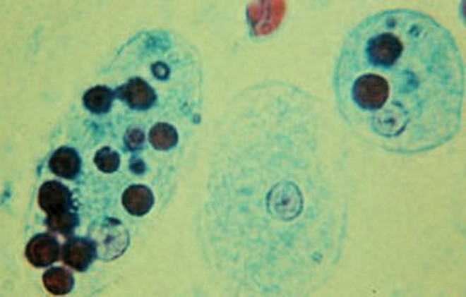Трофозоиты Entamoeba histolytica с поглощёнными эритроцитами