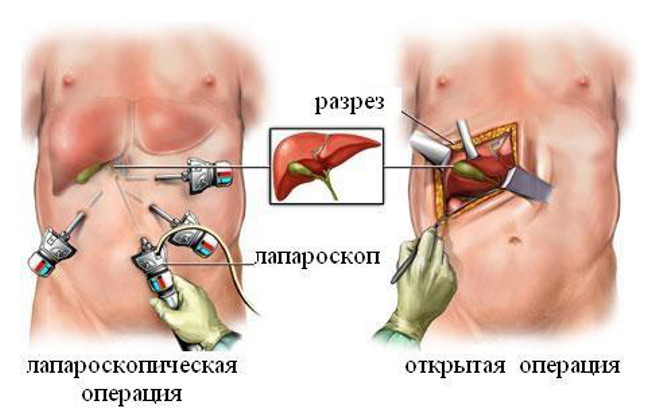 Открытая и лапароскопическая операция при лечении холецистита