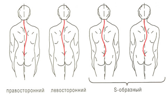 Виды сколиоза: правосторонний, левосторонний и S-образный