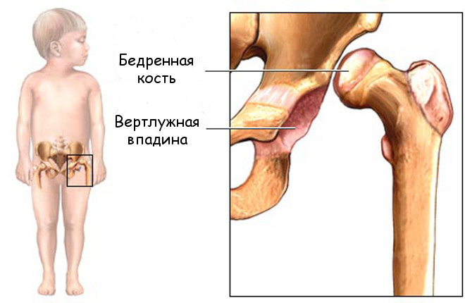 Схема дисплазии тазобедренного сустава