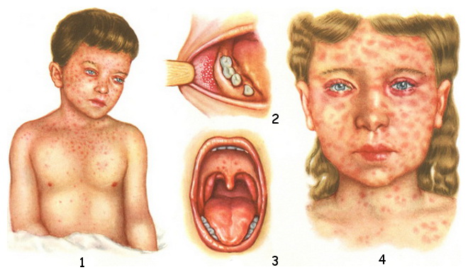 Основные симптомы кори:  1 и 4 - коревая сыпь; 2 - симптом Бельского-Филатова-Коплика; 3 - энантема в продромальном периоде кори.