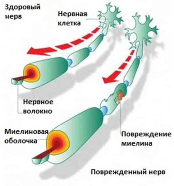 Поражение миелиновой оболочки нерва при рассеянном склерозе