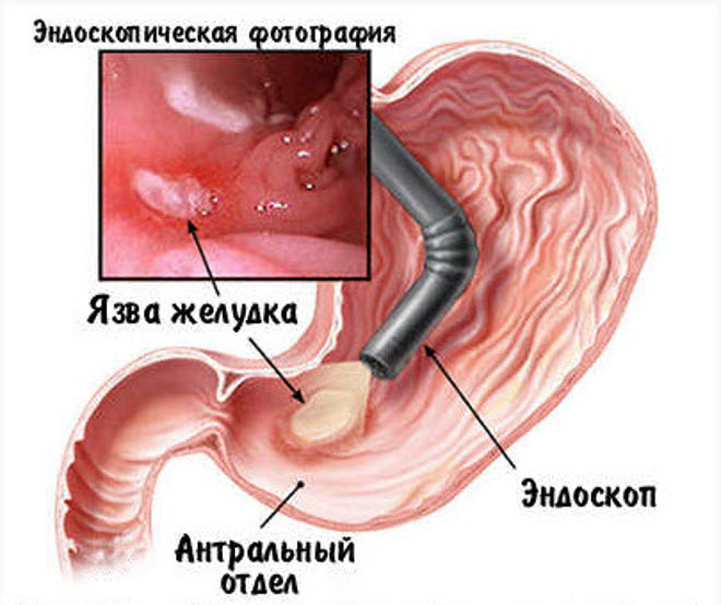 Фиброэзофагогастроскопия