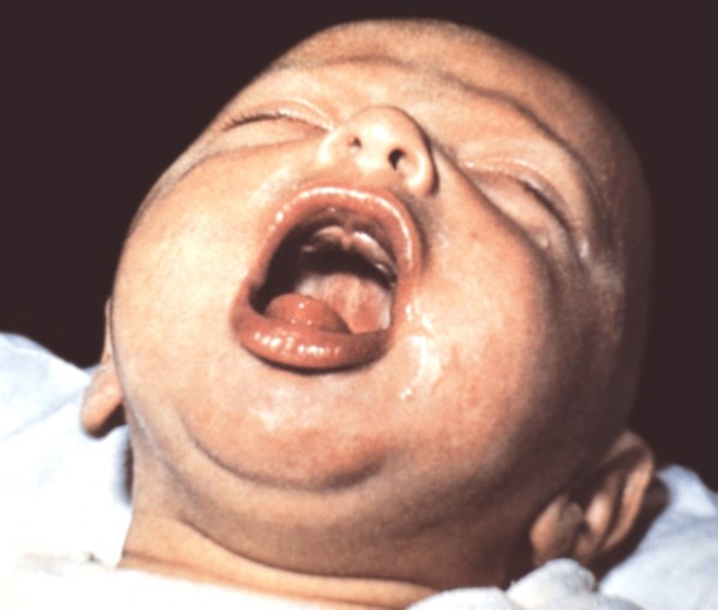 Внешний вид ребенка, больного коклюшем, во время приступа спазматического кашля