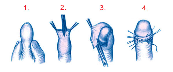 Принцип лечения методом обрезания крайней плоти полового члена