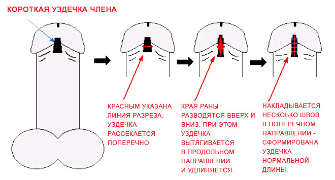 Фленулотомии – разновидности пластической операции по удлинению уздечки полового член