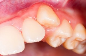 Dental displacement