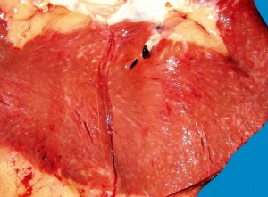 Мелкоочаговый кардиосклероз: профилактика, причины и симптомы болезни