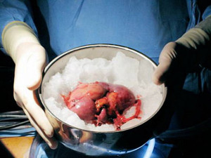 Причины ухудшения статистики трансплантации