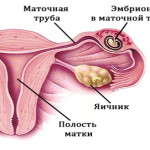 Причины внематочной беременности