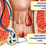 Разные виды лечения геморроя