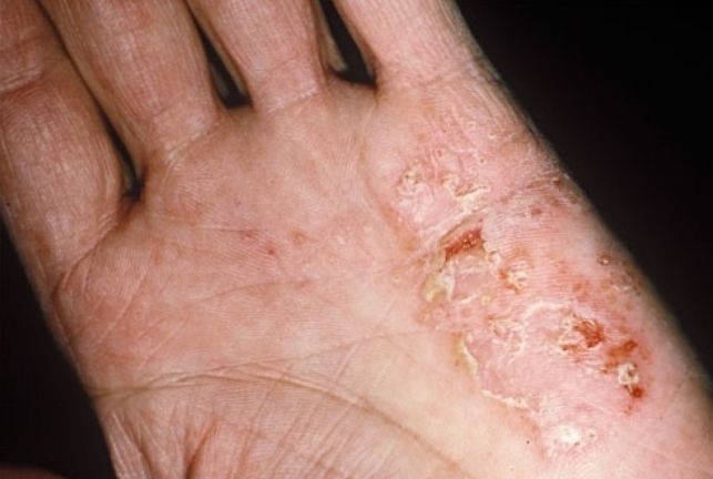 Pochemu pojavljaetsja gribkovaja infekcija kozhi ruk