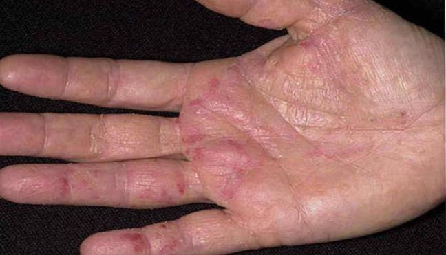 Pochemu pojavljaetsja gribkovaja infekcija kozhi ruk1