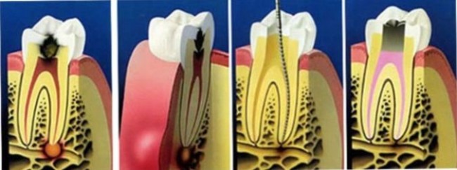 mikrobnaja-specifichnost'-periodontit