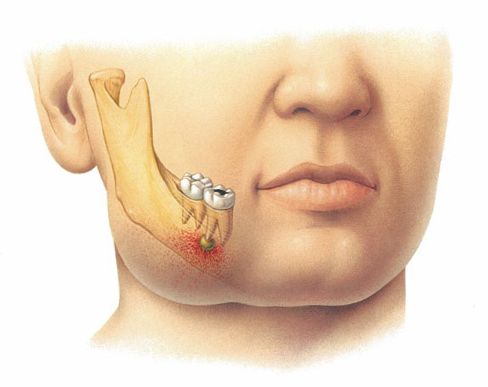 mikrobnaja-specifichnost'-periodontit1