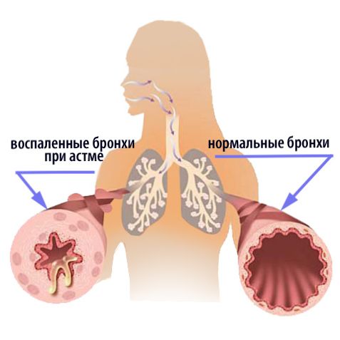 prichiny-razvitija-bronhial'noj-astmy
