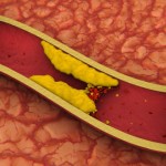 Д-р Эрнандес: малоуглеводные диеты могут стать причиной повышения холестерина 