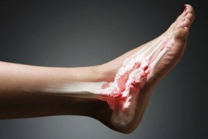О симптоматике и лечении растяжения мышц ноги (Травматология)