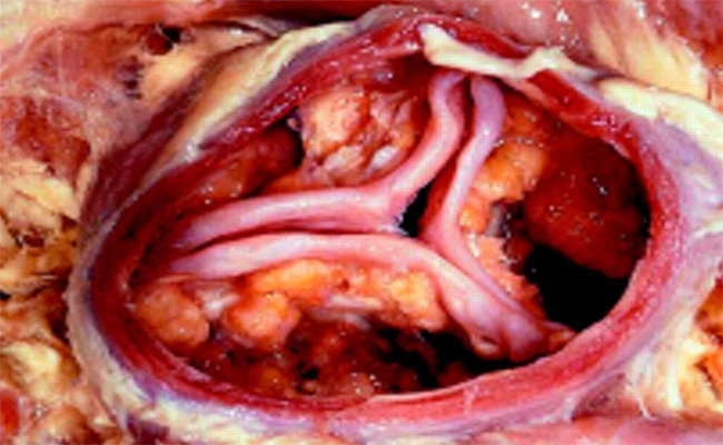 Подклапанный аортальный стеноз