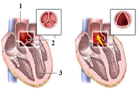 Методы лечения аортального стеноза