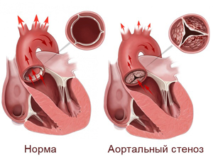 аортальный-стеноз